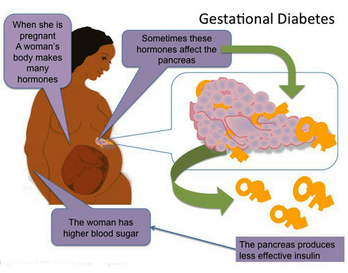 Gestational Diabetes Treatment in Jaipur