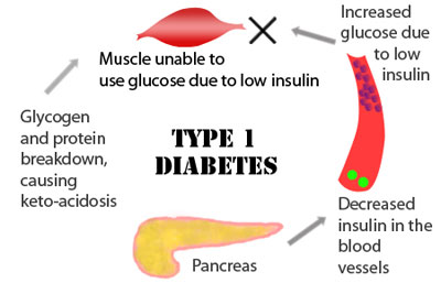 Diabetes Treatment in Jaipur