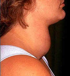 Thyroid Disorder Treatment in Jaipur